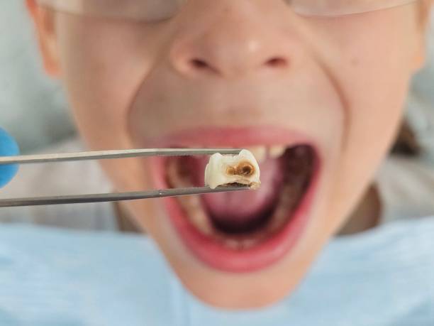 Best Emergency Tooth Extraction in Seagoville, TX